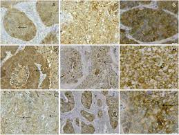 June is national cancer survivor month. Tumor Autophagy Is Associated With Survival Outcomes In Patients With Resected Non Small Cell Lung Cancer Lung Cancer