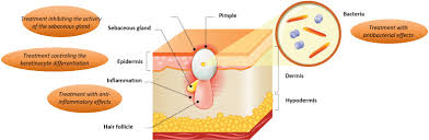 Acne Vulgaris Origins Symptoms And Current Treatments
