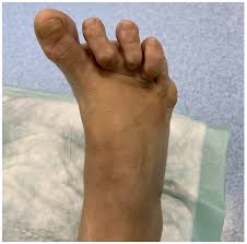 Image result for Hallux Varus