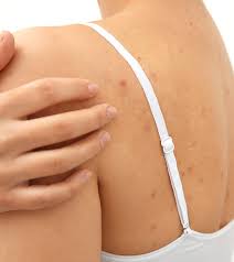Maybe you would like to learn more about one of these? Howto How To Get Rid Of Acne On Back And Shoulders