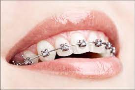 £3,500 to £4,500 in private clinics (prices differ with the nhs) about: Types Of Dental Braces In India The Dental Specialists