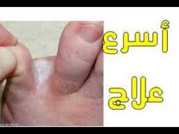 أسرع وأرخص وأبسط علاج لفطريات القدمين يمكن أن تتخيله جربه وإدعيلى Youtube