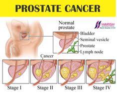 If breast cancer is diagnosed at an early enough stage, it's treatable. Tyrone Tyrone0734 Profile Pinterest