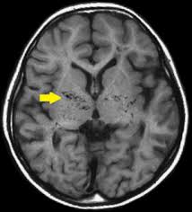 Moyamoya Disease Wikipedia