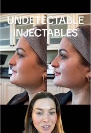 Botox and Filler Face Transformation Journey