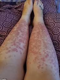 Soprano xl combines the gold standard features of 810nm diode hair. Freedomroo Woman S Body Reacted With Huge Hot Hives After Laser Hair Removal Procedure Australiannewsreview