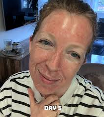 I Tried Photo Dynamic Therapy