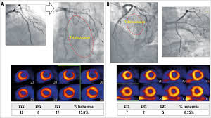Where does the left anterior descending artery supply blood to? Anatomical Attributes Of Clinically Relevant Diagonal Branches In Patients With Left Anterior Descending Coronary Artery Bifurcation Lesions