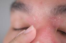 Image result for psoriasis