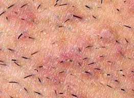 Some conditions that can be mistaken for an ingrown hair include acne, eczema, a cyst, keratosis pilaris, heat rash, impetigo, pustular psoriasis and molluscum contagiosum. Infected Ingrown Hair Pictures Symptoms Treatment Removal