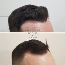 Fue hair transplant methods offer patients advantages versus the strip method (fut). Before After Fue Hair Transplant In London Treatment Rooms London