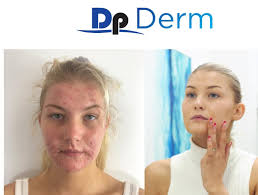 What is the best microneedling pen for a mobile med spa business?