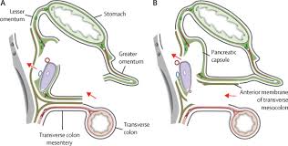 5 the world health prognostic significance of intraoperatively estimated surgical stage in curatively resected gastric. Bursectomy Versus Omentectomy Alone For Resectable Gastric Cancer Jcog1001 A Phase 3 Open Label Randomised Controlled Trial The Lancet Gastroenterology Hepatology