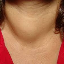 Image result for Goiter