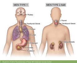 Thyroid cancer starts in the cells of the thyroid. Multiple Endocrine Neoplasia Md Anderson Cancer Center