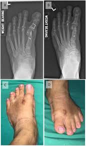 Image result for Hallux Varus