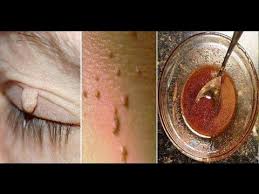 Elimina Facilmente Cualquier Fibroma O Verruga Con 1 Ingrediente Las Verrugas O Fibromas Son Tan Como Eliminar Las Verrugas Eliminar Las Verrugas Verrugas