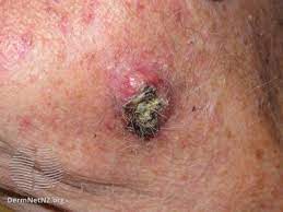 Cancer lumps usually don't hurt. How To Tell A Lump From A Lymph Node
