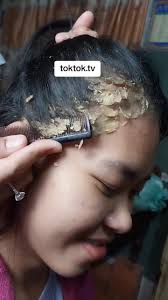 Huge Dandruff Removal Flakes Mrs Amanda