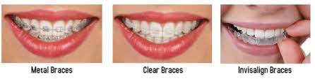 What happens if you never take off your braces? How Much Do Braces For Adults Cost Brier Creek Orthodontics