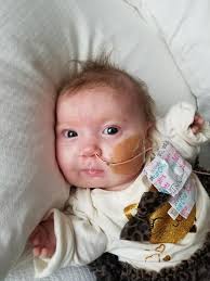 562-- the number of days Macie has had some sort of feeding tube. 122 days  with an OG or NG tube. 440 days with a PEG tube (g tube) but for the