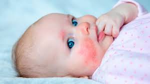 Image result for Allergic Colitis of Infancy