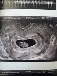 Transvaginal 8 Semanas Gravidissima Outubro De 2020 Babycenter
