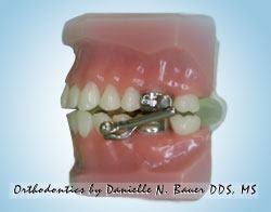 However, the success rate for surgery is high, and failures usually occur from infections, medications, and allergies. Herbst Appliance Mara Appliance Wheaton Orthodontist Bauer Smiles