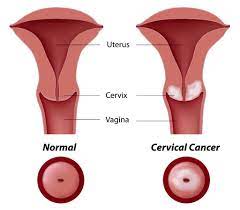 Cervical cancer often develops without causing any particular symptoms, especially at an early these symptoms can be found in the disease other than cervical cancer, but it is important to how to prevent thyroid eye disease. Cervical Cancer Symptoms That You Should Know