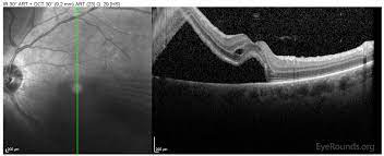 Check spelling or type a new query. Rhegmatogenous Retinal Detachment The University Of Iowa Ophthalmology