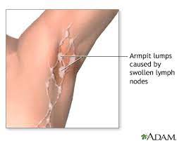 Swollen Lymph Nodes Under Arm Swollen Lymph Nodes Lymph Glands Lymph Nodes