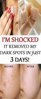 I M Shocked It Removed My Dark Spots In 3 Days Magic Remedy Beauty Remedies Health And Beauty Tips Skin Remedies