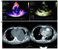Doctors may use the following imaging tests to make a pericardial mesothelioma diagnosis: 18f Fluorodeoxyglucose Imaging Of Primary Malignant Pericardial Mesothelioma With Concurrent Pericardial And Pleural Effusions And Bone Metastasis A Case Report