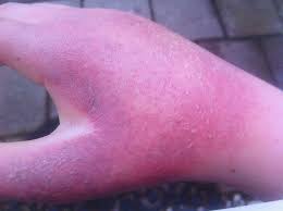 Erythropoietic... - American Porphyria Foundation | Facebook