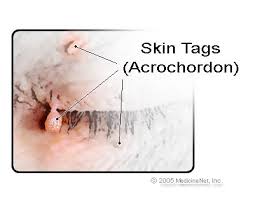 The thrombosed external hemorrhoid is caused by the vein collapsing and filling up with. Skin Tags Causes Pictures Remedies Removal