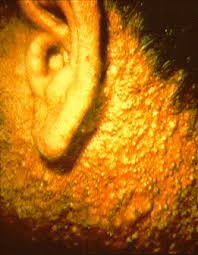 A papule is a circumscribed, solid elevation of skin with no visible fluid, varying in area from a pinhead to 1 cm. Chloracne Wikipedia