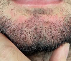 Image result for Seborrheic Dermatitis