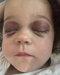 Hello, my name is Kamil and my daughter's name is Charlotte. My vascular  Ehlers-Danlos syndrome (vEDS) was confirmed after the birth of my daughter,  when she was 8 months old, and mine