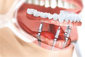 Cat costa un implant dentar pentru toti dintii? Implant Dentar Intrebari Si Raspunsuri Preturi Implanturi Mdlpl