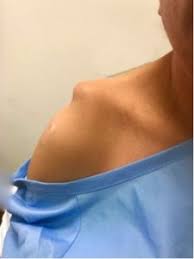 If the ligaments in the ac joint are torn, the condition is more severe (grade 2). Ac Joint Separation Recovery Time Shoulder Separation Dr Steven Struhl Nyc