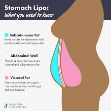 The best candidates, in fact, are generally within 30 percent of a healthy weight range and have localized fat pockets they would like to reduce. Can You Get A Flat Stomach With Liposuction Houston Lipo Center