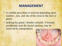 Image result for Sialolithiasis