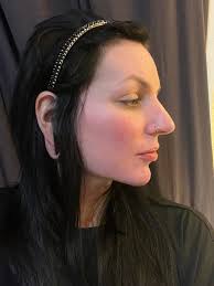 Hello, does anyone have the link to the WhatsApp group for Dr. Ozan Erol? I  am scheduling a primary Rhinoplasty with him in November. Also if anyone  has any useful information on