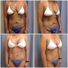 Also some type of breast operation, either a lift, reduction or augmentation. Mommy Makeover Beauty Mds