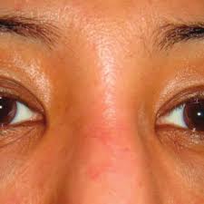Ad by beverly hills md. Pdf Non Surgical Epicanthoplasty And Rhinoplasty Epicanthorhinoplasty
