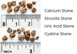 Image result for Calcium Nephrolithiasis