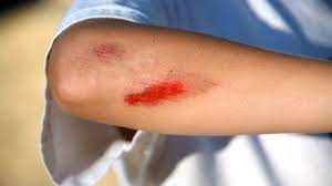 How To Treat Cuts & Scrapes | First Aid Training - Youtube
