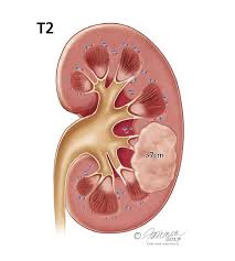 We did not find results for: Renal Mass And Localized Renal Tumors Symptoms Diagnosis Treatment Urology Care Foundation