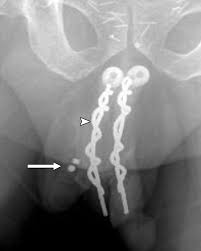 Image result for Penile Prosthesis