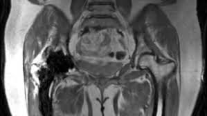 In some cases, it may take up to about 2 hours. Mri Near Metal Body Mri Research Group Bmr Stanford Medicine
